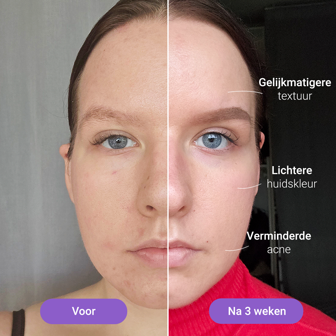 Lumi Lichtherapiemasker