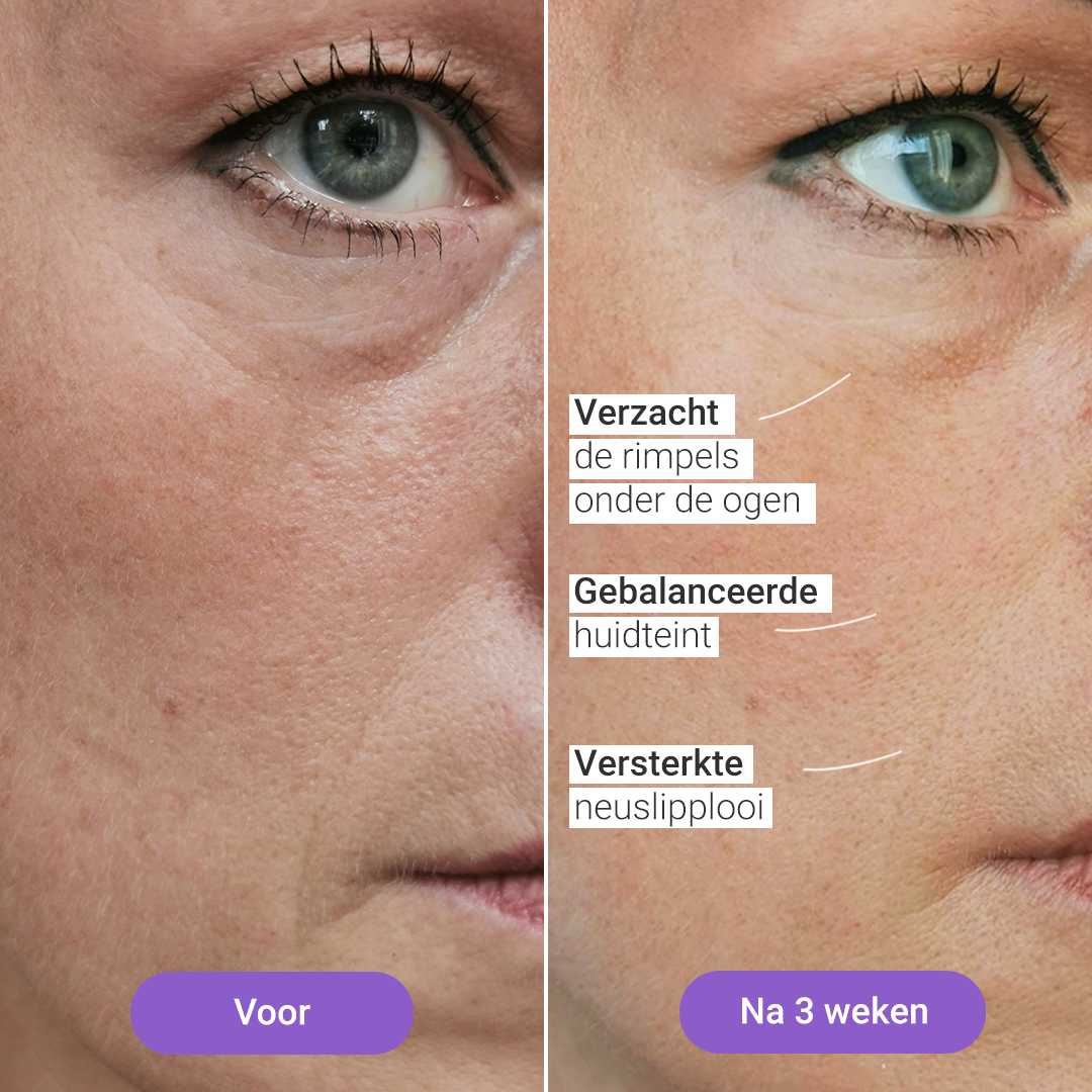 Lumi Lichtherapiemasker