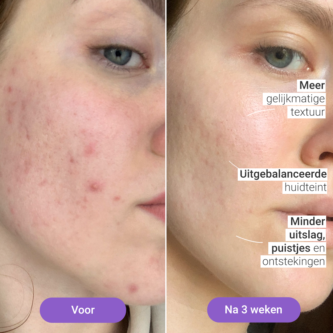 Lumi Lichtherapiemasker